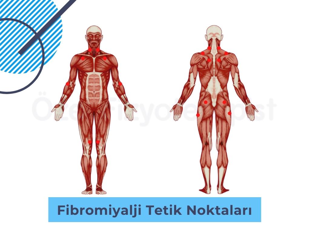 fibromiyalji noktaları